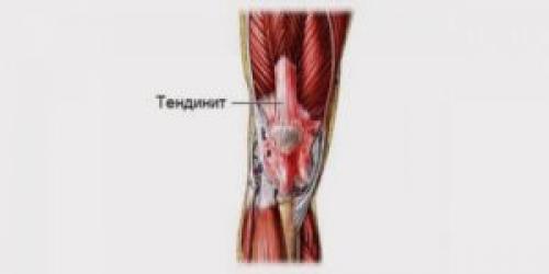 Опухло колено, но не болит. Колено опухло, но не болит: причины, что это может быть, диагностика и лечение