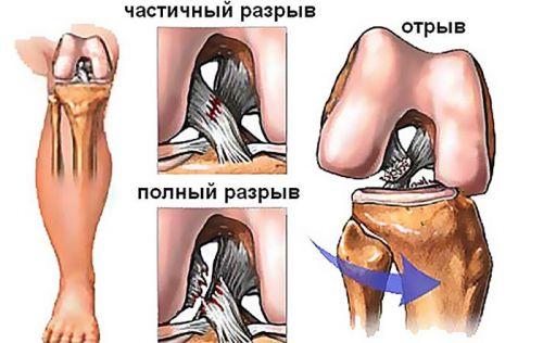 Коленка болит и горячая. Колено горячее и болит. В чем причина и что делать 02 Коленка болит и горячая. Колено горячее и болит. В чем причина и что делать 02