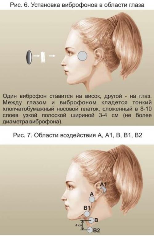 Витафо. Области воздействия и места установки виброфонов