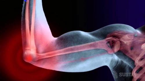 Не разгибается рука в локте до конца после травмы. Почему может не разгибаться локоть?