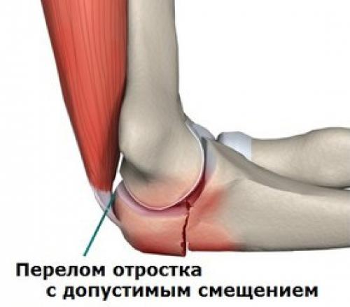 Перелом локтевого сустава. Виды переломов локтевой кости 02 Перелом локтевого сустава. Виды переломов локтевой кости 02