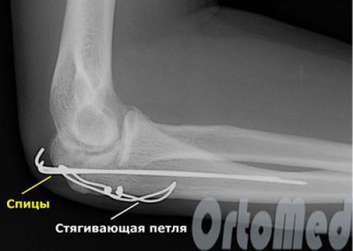 Перелом локтевого сустава. Виды переломов локтевой кости 05 Перелом локтевого сустава. Виды переломов локтевой кости 05