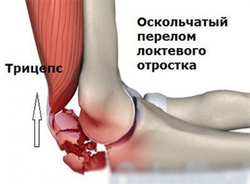 Перелом локтевого сустава. Виды переломов локтевой кости 01 Перелом локтевого сустава. Виды переломов локтевой кости 01