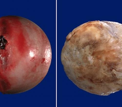 Мазь при коксартрозе тазобедренного сустава 3 степени. Коксартроз тазобедренного сустава 3 степени: лечение без операции
