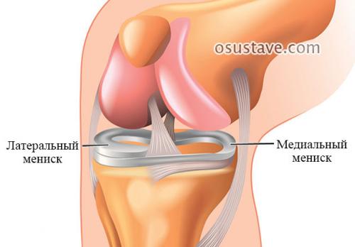 Травма мениска. Виды повреждений мениска коленного сустава: их обзор, степени, симптомы и лечение