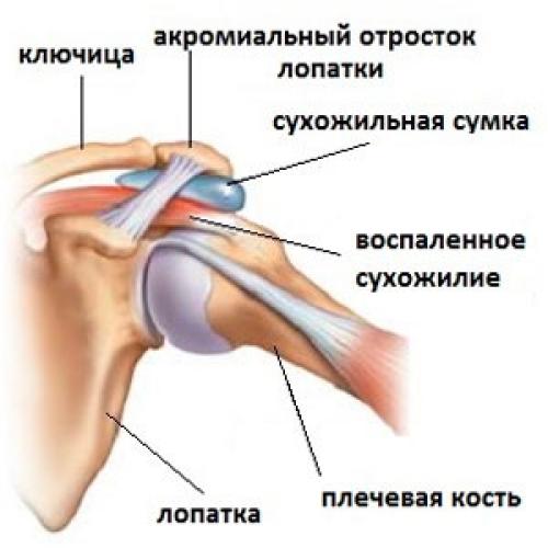 Боль в плечевом суставе правой руки. Схема сухожилий плечевого сустава. Периартрит плечевого сустава. Акромиальный отросток.