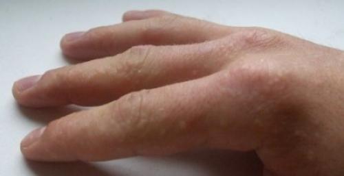 На фалангах пальцев появляются водяные пузырьки. Что делать, если появились водянистые пузырьки на пальцах рук?