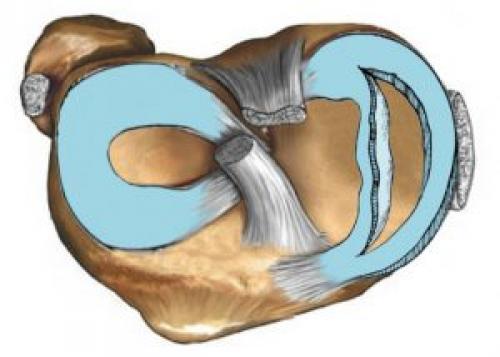 Защемление мениска симптомы. Лечение защемления мениска коленного сустава