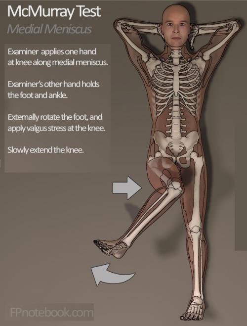 Лечение разрыва мениска коленного сустава. Причины возникновения травмированности 01