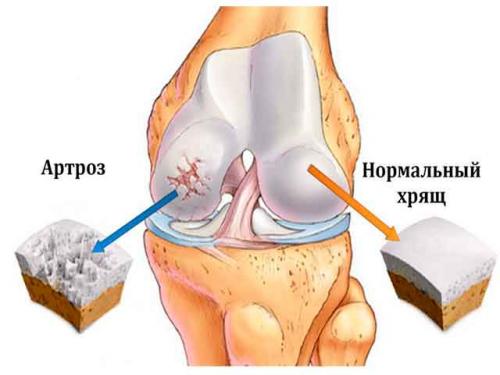 Польза для суставов. Полезные продукты при артрозе суставов
