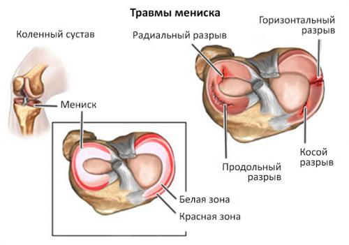 Стоит ли делать операцию на мениск. Техника полного и частичного удаления мениска, эффективность операции, осложнения