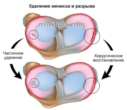 Стоит ли делать операцию на мениск. Техника полного и частичного удаления мениска, эффективность операции, осложнения