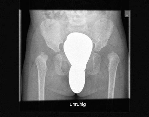 Ацетабулярные углы норма таблица в 7 месяцев. Виды (типы) дисплазии тазобедренных суставов