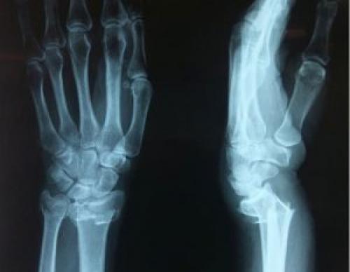 Головка лучевой кости. Локализация и строение головки лучевой кости 02