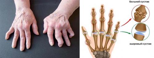 Опух сустав на пальце руки, что делать. Основные причины и методы лечения опухших суставов пальцев на руке