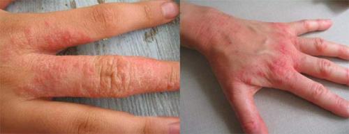 Опух сустав на пальце руки, что делать. Основные причины и методы лечения опухших суставов пальцев на руке