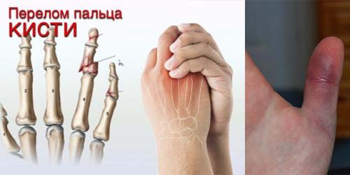 Опух сустав на пальце руки, что делать. Основные причины и методы лечения опухших суставов пальцев на руке