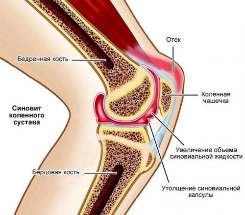 Артрит правого голеностопного сустава код по МКБ-10. Что такое синовит коленного сустава