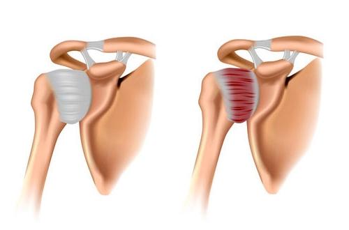 Боль в плече в состоянии покоя. Заболевания с данной симптоматикой