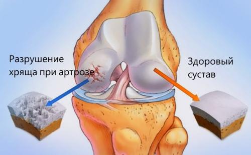Код по МКБ-10 артрит голеностопного сустава. Артрозо-артрит голеностопного сустава: код мкб-10, симптомы и лечение