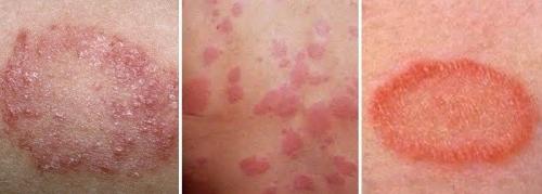 Красные пятна на пальцах ног чешутся и болят форум появляются только зимой. Причины шелушения и красных пятен на ногах