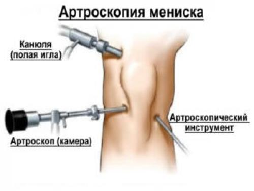 Разрыв мениска, какая степень тяжести травмы. Ответ, который может дать юрист
