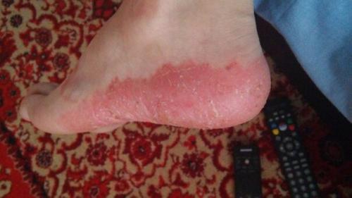 Красные пятнышки на пальцах ноги без зуда. Красные пятна на ступнях симптом некоторых заболеваний