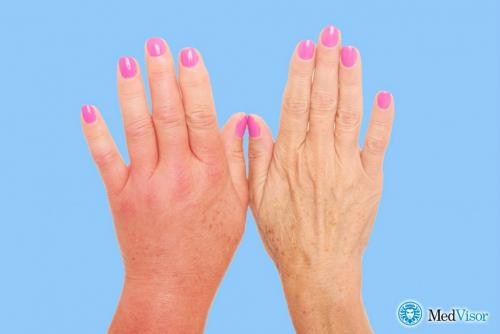 Сводит мышцы рук. Судороги в кистях руки: причины