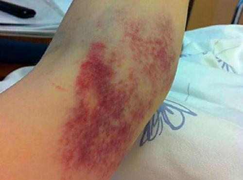 Ушиб локтевого нерва лечение. Обзор ушиба локтевого сустава: виды, степени, симптомы и лечение