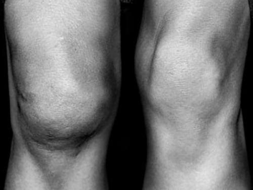 Застарелое повреждение медиального мениска. Виды внутреннего и наружного повреждение мениска коленного сустава 01