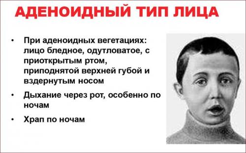 Как избавиться от аденоидов без операции это должна знать каждая мама. Симптоматика