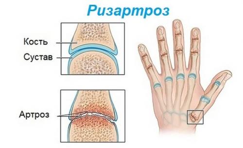 Шишка на пальце руки под кожей болит. Симптомы