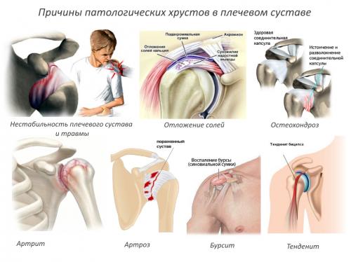 Упражнения при хрусте в плече. От чего появляется хруст в плече