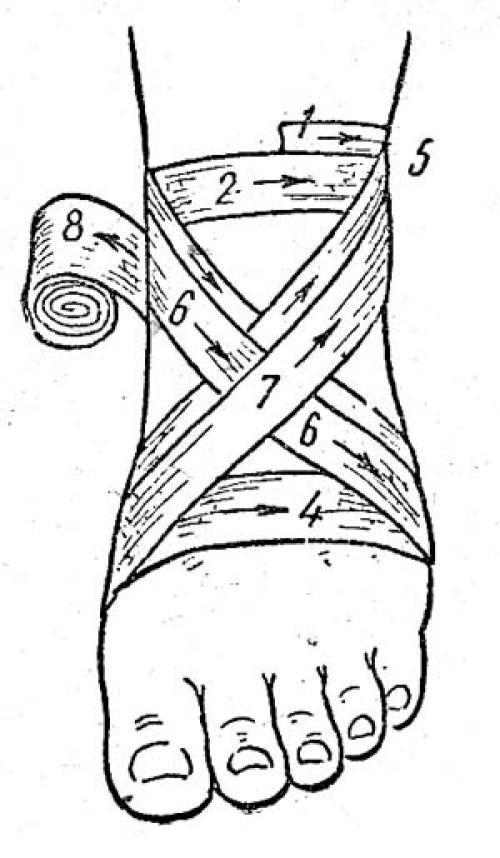 Черепашья повязка сходящаяся. Черепашья повязка на локтевой и коленный сустав (сходящаяся и расходящаяся) 07
