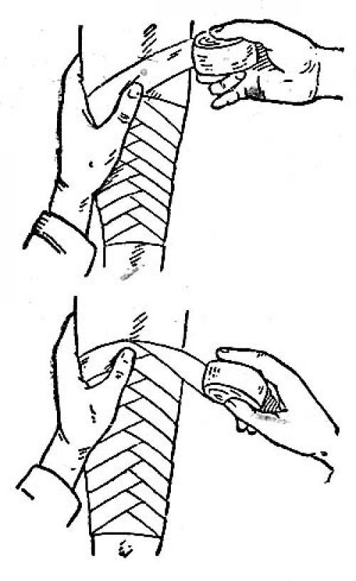 Черепашья повязка сходящаяся. Черепашья повязка на локтевой и коленный сустав (сходящаяся и расходящаяся) 06
