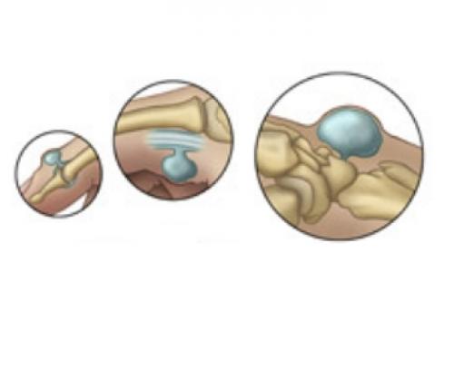 Если растут косточки на ногах где мизинец. Шишка на мизинце (гигрома)