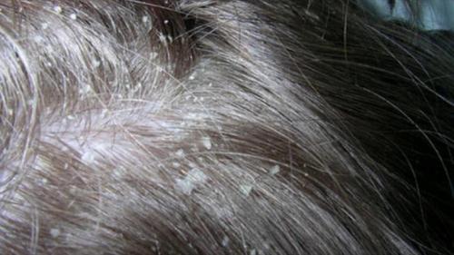 Маска от перхоти с содой. Сода от перхоти: особенности применения, противопоказания, рецепты