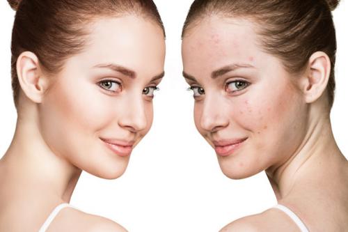 Маска от прыщей своими руками. Кому можно делать маски против прыщей в домашних условиях?