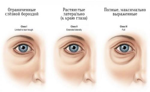 Как избавиться от синяков под глазами навсегда. Корректируем образ жизни