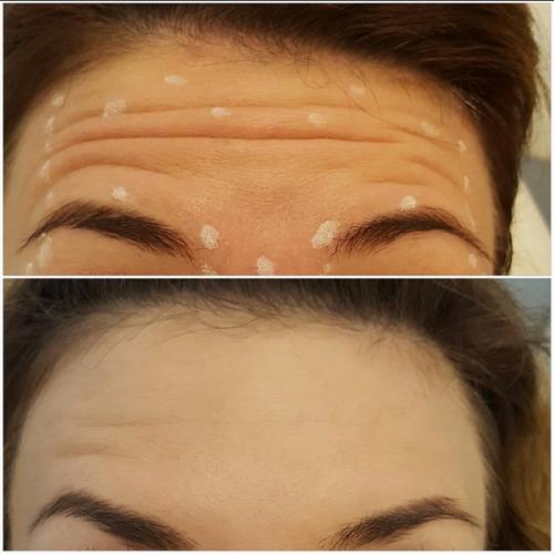 Замена Ботокса и диспорта. Диспорт (Dysport) — наиболее именитый аналог Ботокса (Botox)