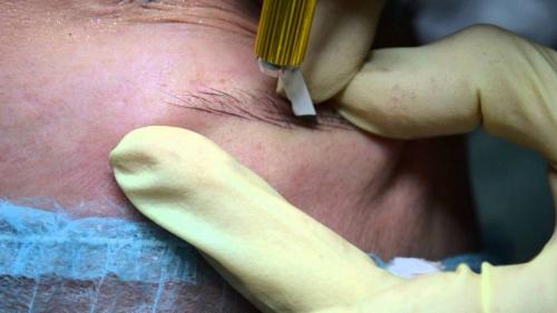 Микроблейдинг частично.  ЧТО ТАКОЕ „МИКРОБЛЭЙДИНГ“?