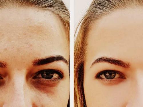 Как убрать темные круги под глазами за 5 минут. Как убрать отёки и тёмные круги