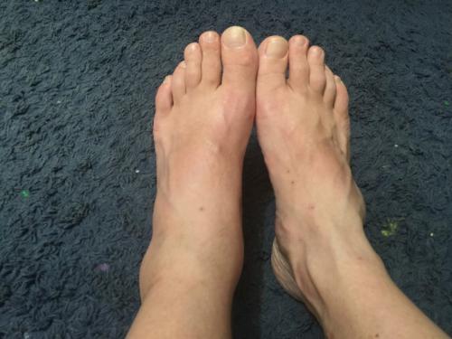 Асептический некроз ладьевидной кости стопы. Блог им. Bodya - Ищу ортопеда-травматолога. Диагноз - асептический некроз ладьевидной кости