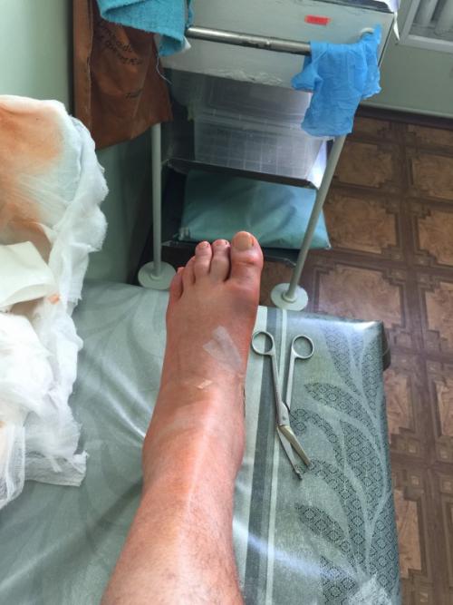 Асептический некроз ладьевидной кости стопы. Блог им. Bodya - Ищу ортопеда-травматолога. Диагноз - асептический некроз ладьевидной кости