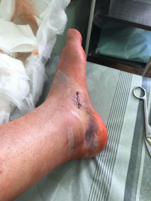 Асептический некроз ладьевидной кости стопы. Блог им. Bodya - Ищу ортопеда-травматолога. Диагноз - асептический некроз ладьевидной кости