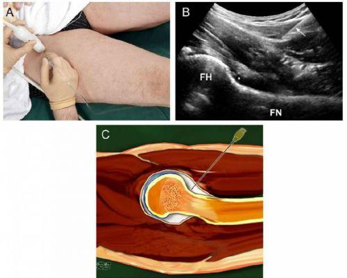 Укол гиалуроновой кислоты в сустав коленный сустав. Гиалуроновая кислота для суставов 03