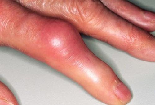 Утолщение суставов пальцев рук причины. Признаки и симптомы. К какому врачу обращаться