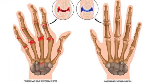 Желатин при лечении суставов рецепт. Польза желатина для суставов. Простые рецепты с желатином 05