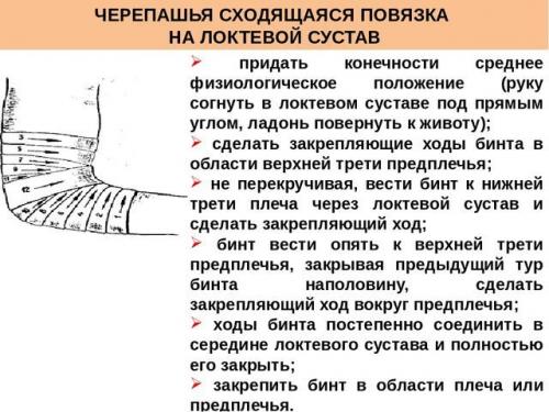 Черепашья повязка на локтевой сустав. Техника наложения повязки черепашья на локтевой сустав