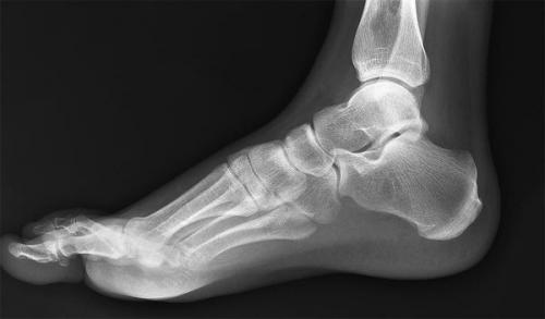 Утолщение суставов на запястье и голеностоп. Информативность метода